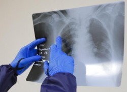 “Uneori este prea... târziu să mai poată fi salvaţi” , avertizează medicii arădeni în urma leziunilor pulmonare regăsite la pacienții infectați cu SARS CoV-2