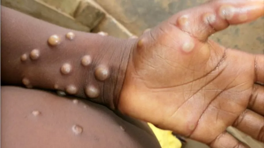 Primul caz de variola maimuței diagnosticat în România. Este vorba despre un bărbat în vârstă de 26 de ani din București