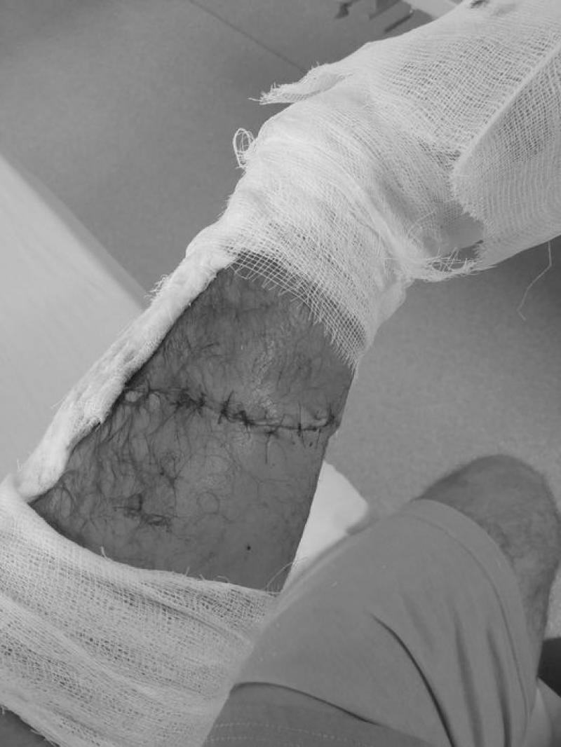 Brațul unui arădean de 43 de ani a fost salvat în urma unei intervenții chirurgicale dificile realizată de medicul Andreas Baizat de la Spitalul Județean Arad

