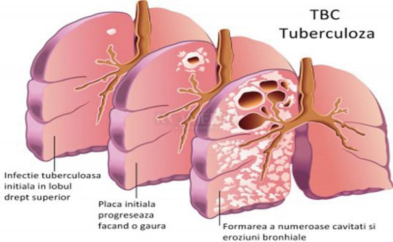 24 martie – Ziua mondială a luptei împotriva tuberculozei 