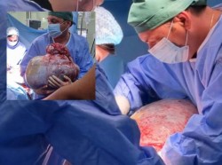 Tumoare gigant de 24 de kilograme extirpată de medicii timișoreni din abdomenul unei paciente de 64 de ani