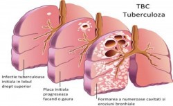 24 martie – Ziua mondială a luptei împotriva tuberculozei