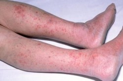 Copil de 5 ani răpus de meningită meningococică