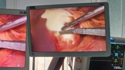 Intervenție chirurgicală deosebită la Spitalul Județean Arad. Chist hidatic hepatic operat laparoscopic
